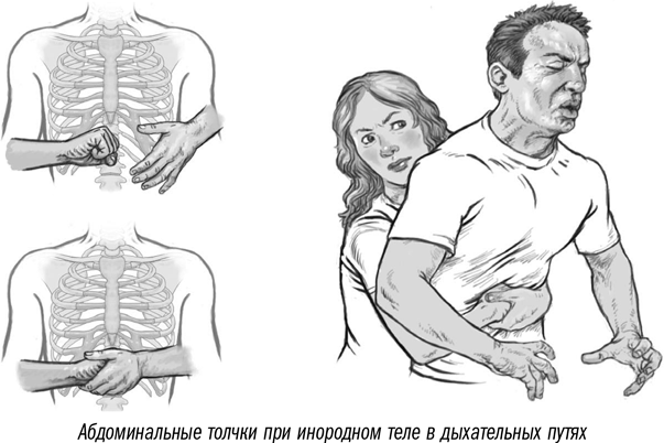 Обучение медсестёр технике извлечения инородных тел из дыхательных путей